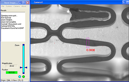 Stent View Screen Capture
